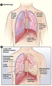 asbestos health problems