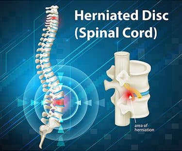 Herniated-disc-c4-c5-settlements