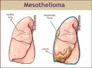 mesothelioma-lawyer-in-Houston