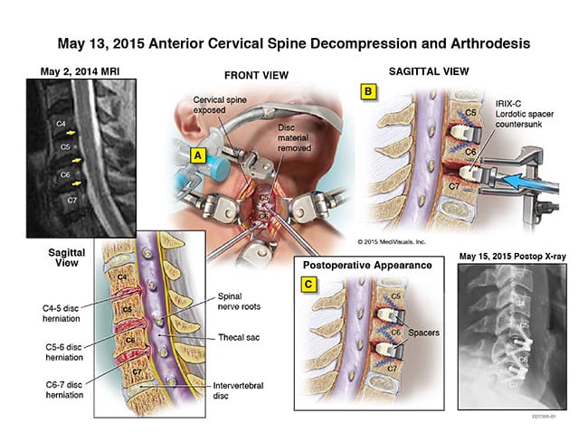 spinal-injury-diagram