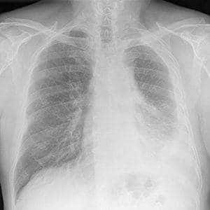 mesothelioma-xray